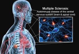 Multiple sclerosis cure