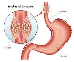 cancer of oesophagus