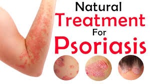 psoriasis cure