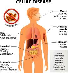 celiac disease and health