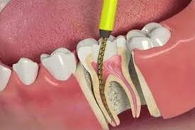root canals and health